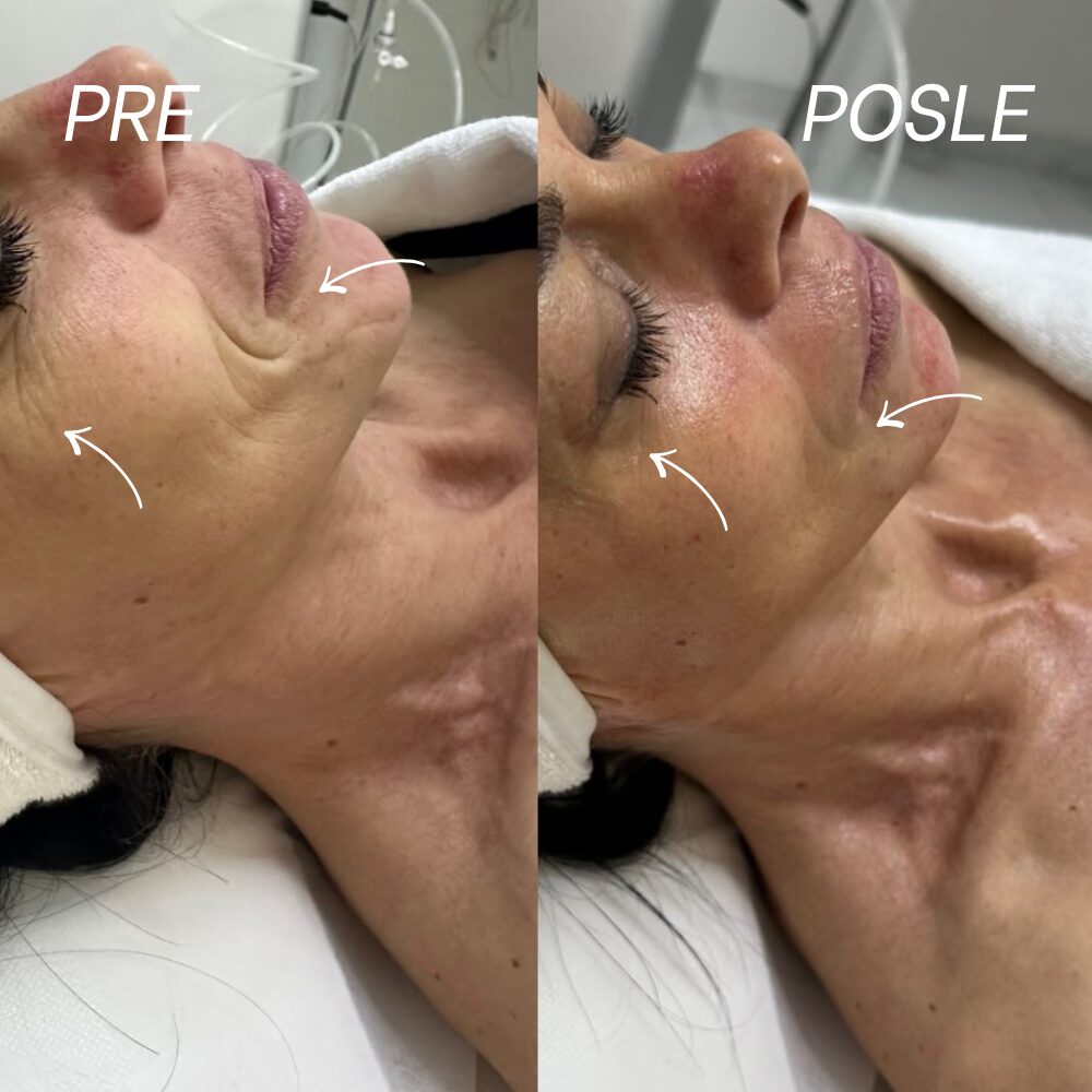 Pre tretmana i posle tretmana, zategnutija koža obraza i vilične linije